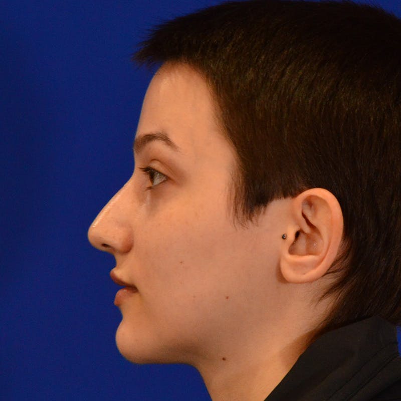 Revision Rhinoplasty Before & After Gallery - Patient 355453 - Image 9