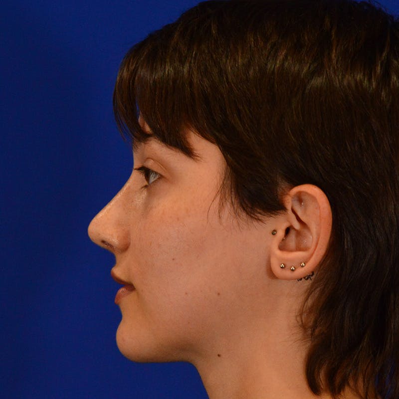 Revision Rhinoplasty Before & After Gallery - Patient 355453 - Image 10