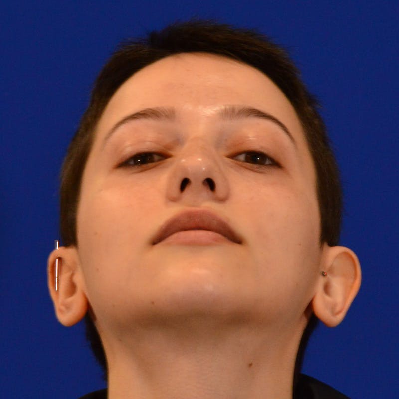 Revision Rhinoplasty Before & After Gallery - Patient 355453 - Image 11
