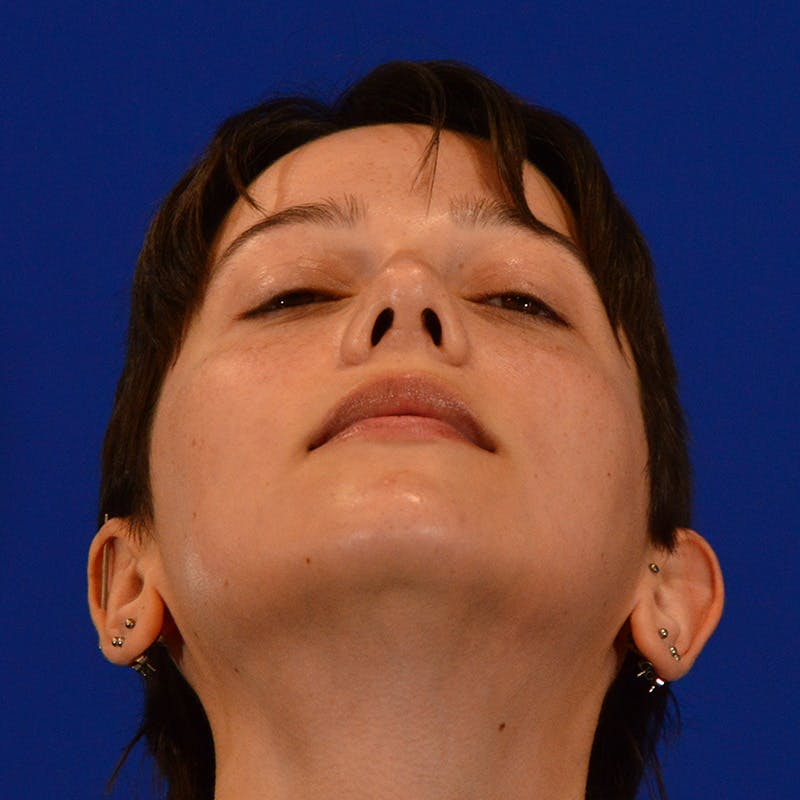 Revision Rhinoplasty Before & After Gallery - Patient 355453 - Image 12
