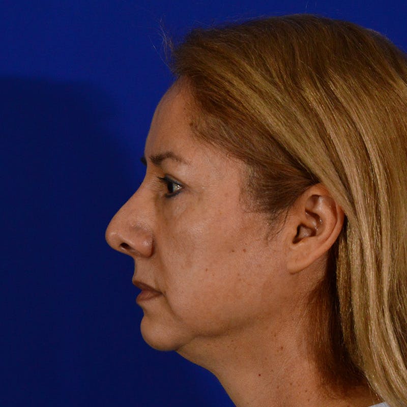 Revision Rhinoplasty Before & After Gallery - Patient 338950 - Image 9