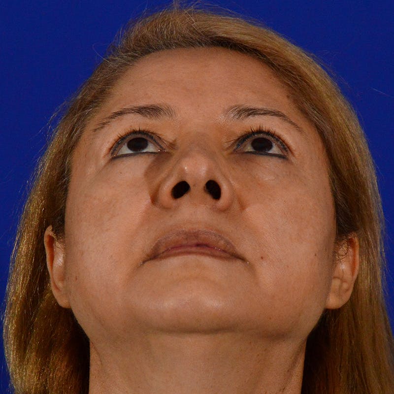 Revision Rhinoplasty Before & After Gallery - Patient 338950 - Image 11