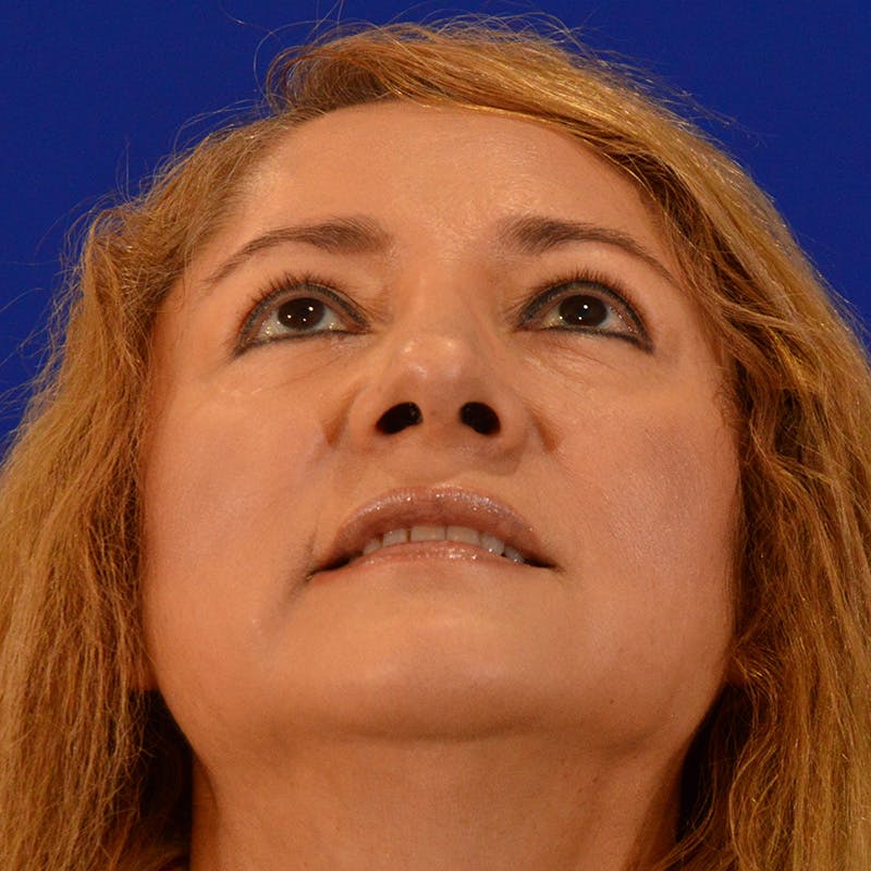 Revision Rhinoplasty Before & After Gallery - Patient 338950 - Image 12
