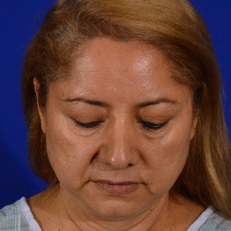 Revision Rhinoplasty Before & After Gallery - Patient 338950 - Image 13