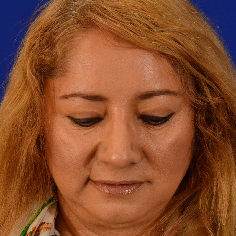 Revision Rhinoplasty Before & After Gallery - Patient 338950 - Image 14