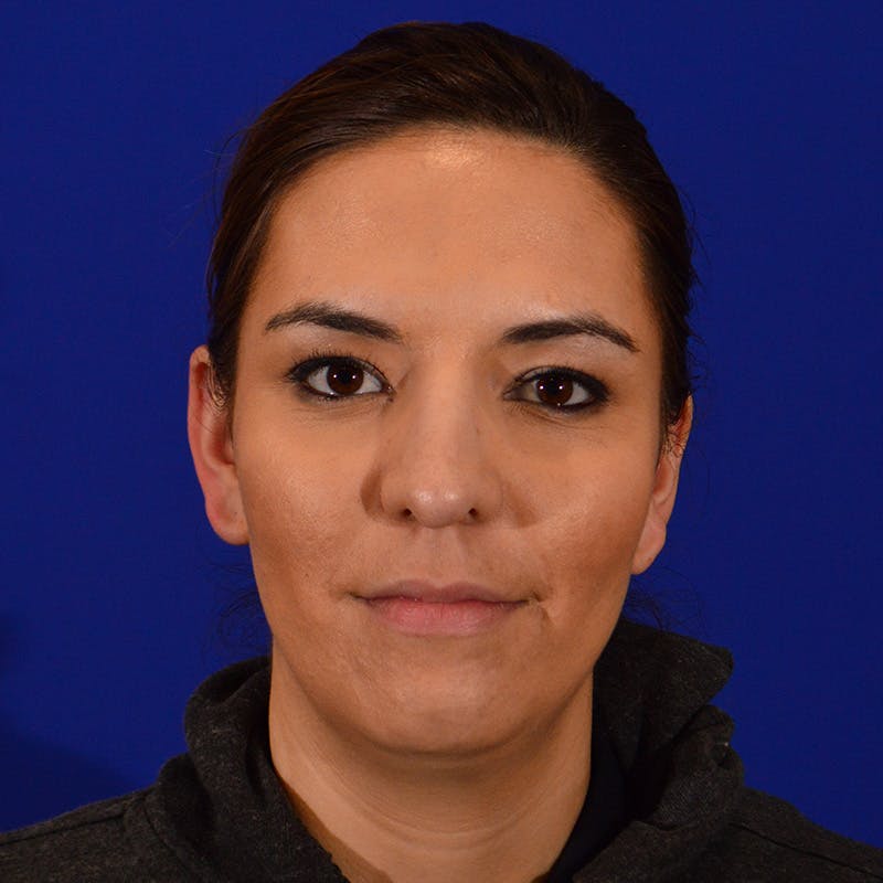 Chin Augmentation Before & After Gallery - Patient 108482 - Image 1