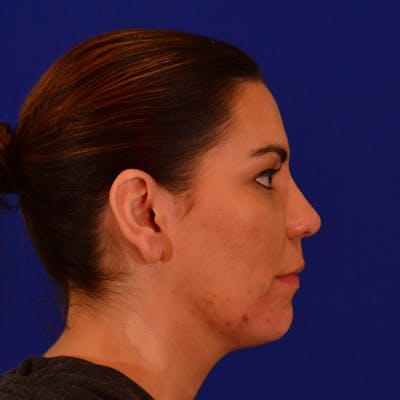 Revision Rhinoplasty Before & After Gallery - Patient 319250 - Image 2