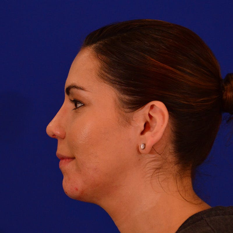 Chin Augmentation Before & After Gallery - Patient 108482 - Image 10