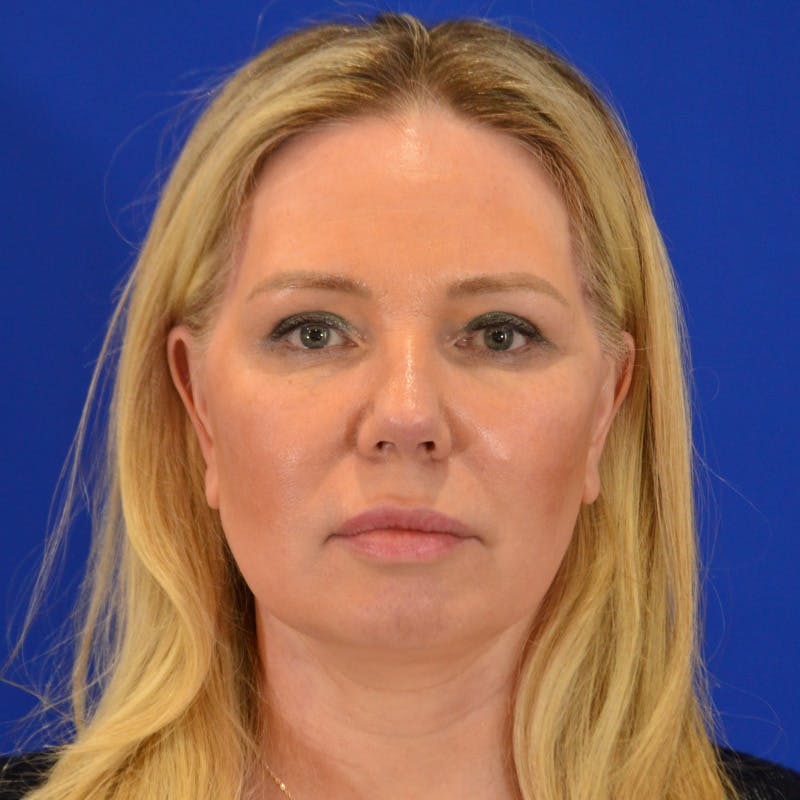 Facelift & Necklift Before & After Gallery - Patient 343161 - Image 2