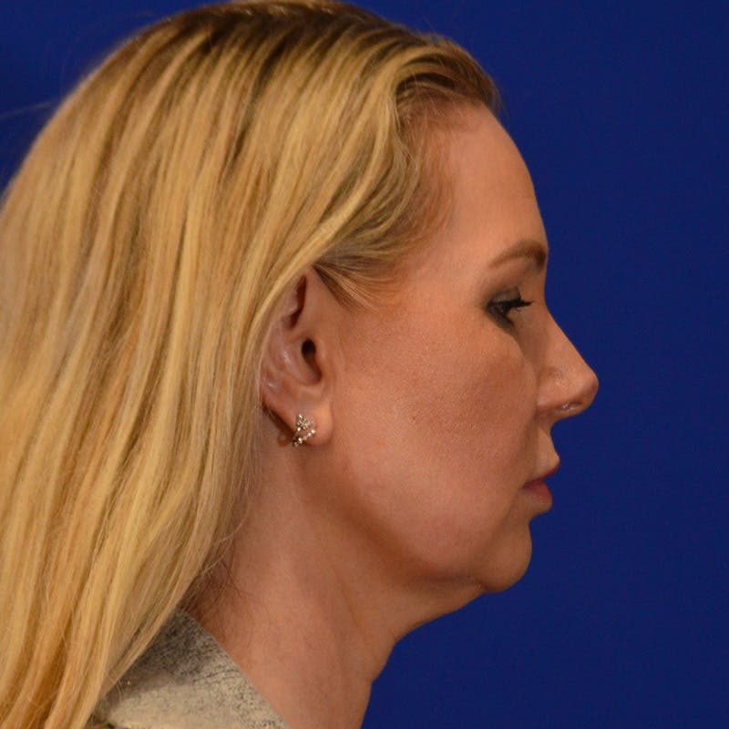 Facelift & Necklift Before & After Gallery - Patient 343161 - Image 5