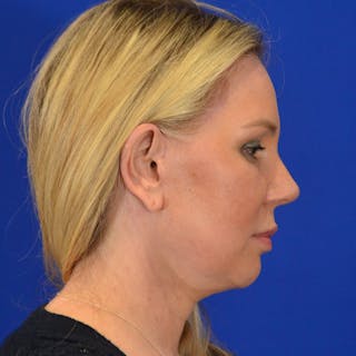 Revision Rhinoplasty Before & After Gallery - Patient 329211 - Image 2