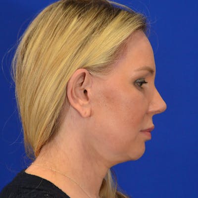 Revision Rhinoplasty Before & After Gallery - Patient 329211 - Image 2