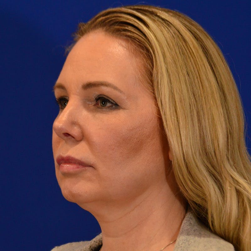 Facelift & Necklift Before & After Gallery - Patient 343161 - Image 7