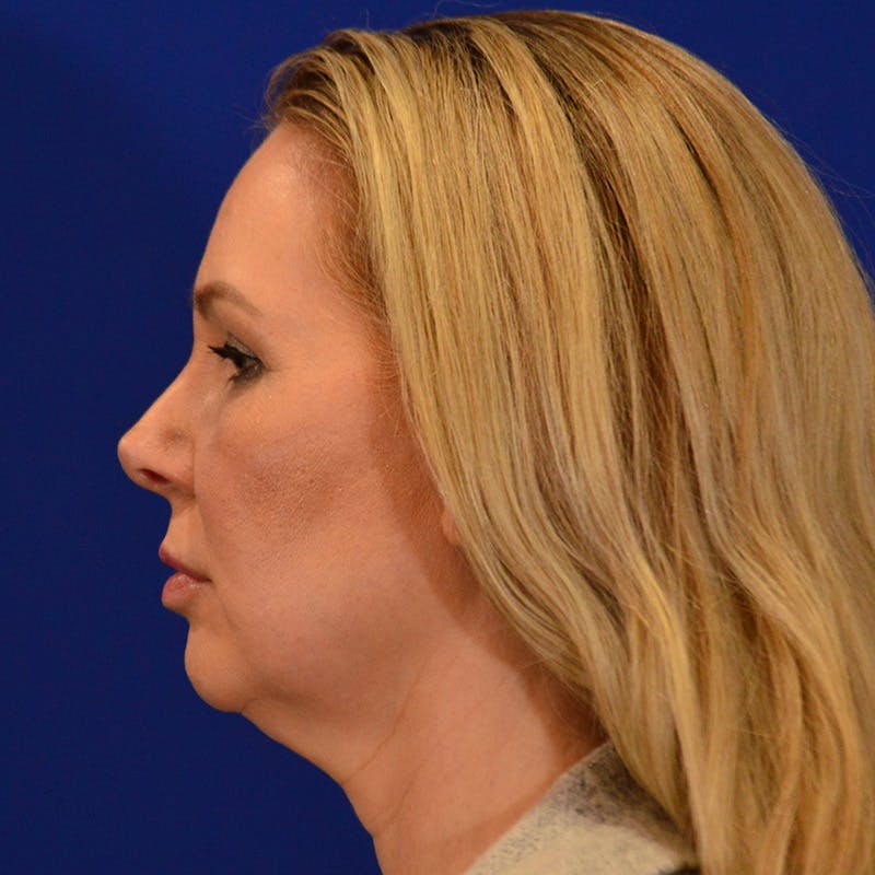 Facelift & Necklift Before & After Gallery - Patient 343161 - Image 9