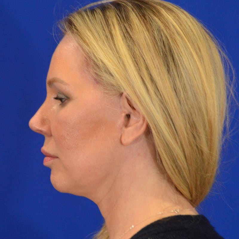 Facelift & Necklift Before & After Gallery - Patient 343161 - Image 10