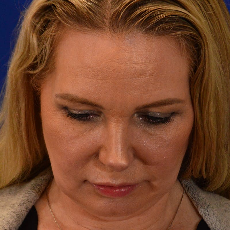 Facelift & Necklift Before & After Gallery - Patient 343161 - Image 13