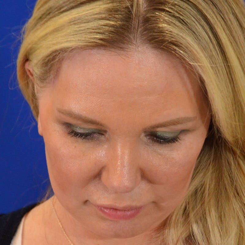 Facelift & Necklift Before & After Gallery - Patient 343161 - Image 14