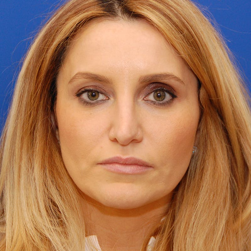 Revision Rhinoplasty Before & After Gallery - Patient 244003 - Image 5