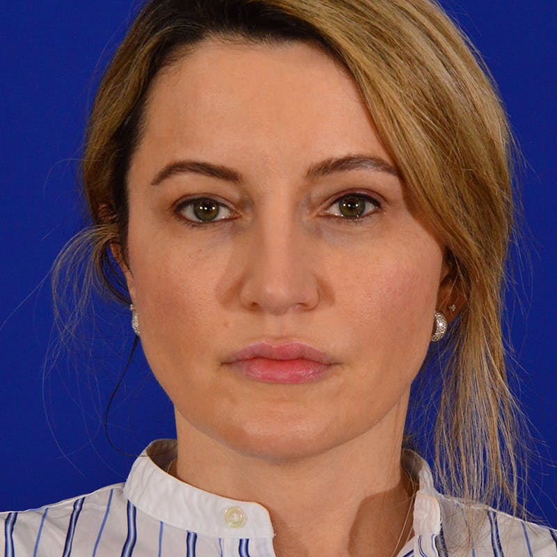 Revision Rhinoplasty Before & After Gallery - Patient 244003 - Image 6