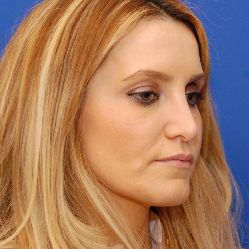 Revision Rhinoplasty Before & After Gallery - Patient 244003 - Image 3