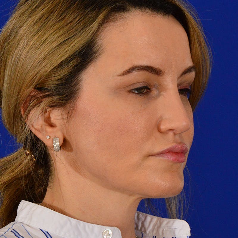 Revision Rhinoplasty Before & After Gallery - Patient 244003 - Image 4