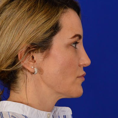 Revision Rhinoplasty Before & After Gallery - Patient 244003 - Image 2