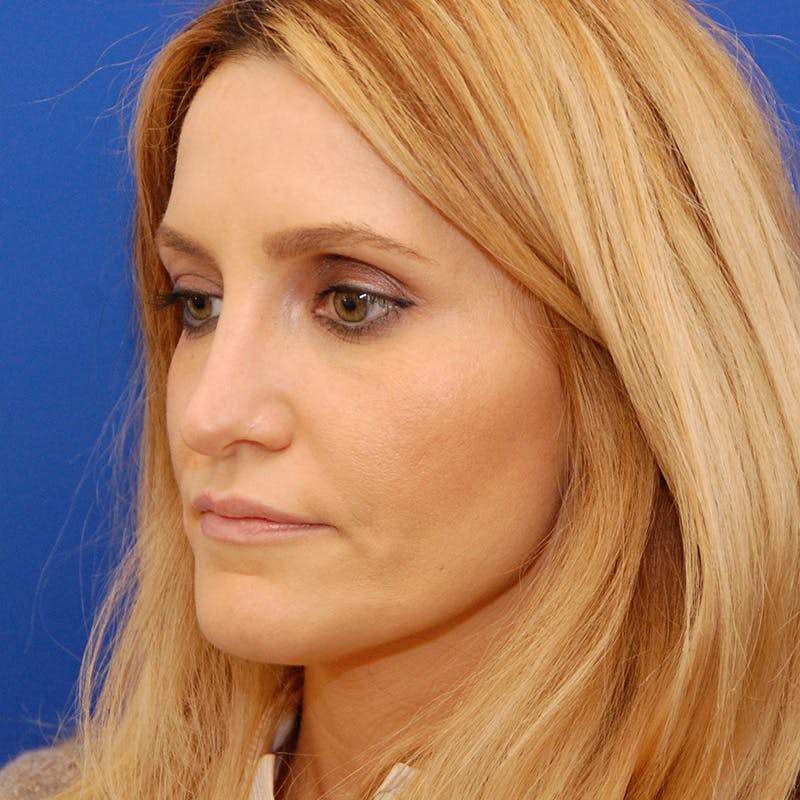 Revision Rhinoplasty Before & After Gallery - Patient 244003 - Image 7