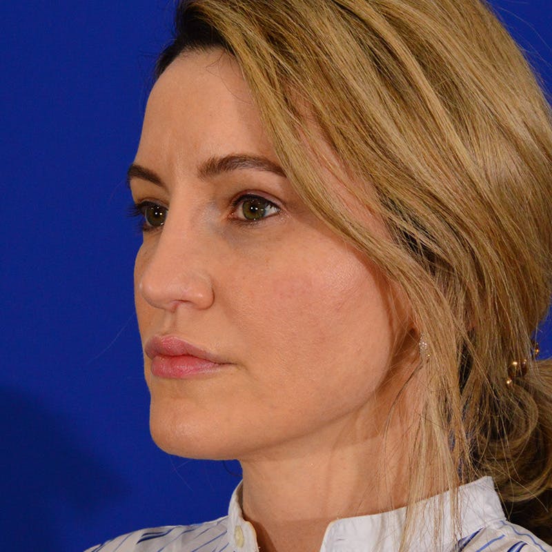 Revision Rhinoplasty Before & After Gallery - Patient 244003 - Image 8