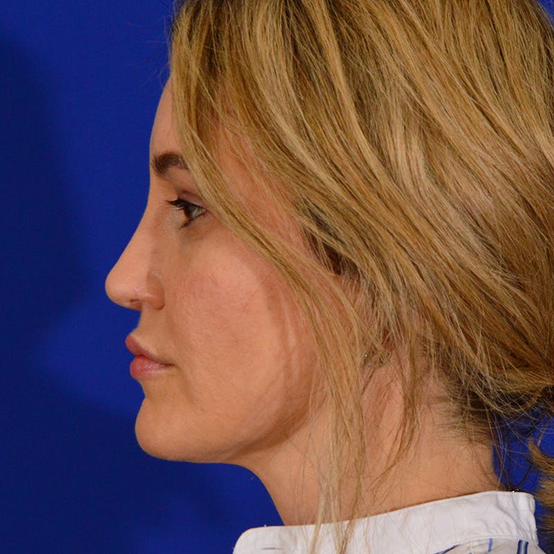 Revision Rhinoplasty Before & After Gallery - Patient 244003 - Image 10