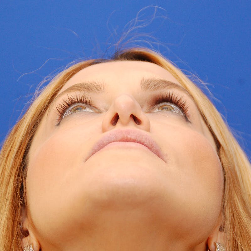 Revision Rhinoplasty Before & After Gallery - Patient 244003 - Image 13