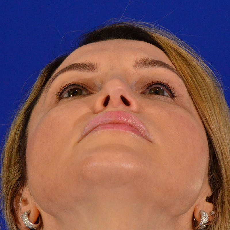 Revision Rhinoplasty Before & After Gallery - Patient 244003 - Image 14