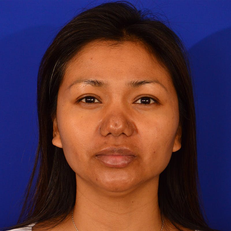 Revision Rhinoplasty Before & After Gallery - Patient 821065 - Image 5
