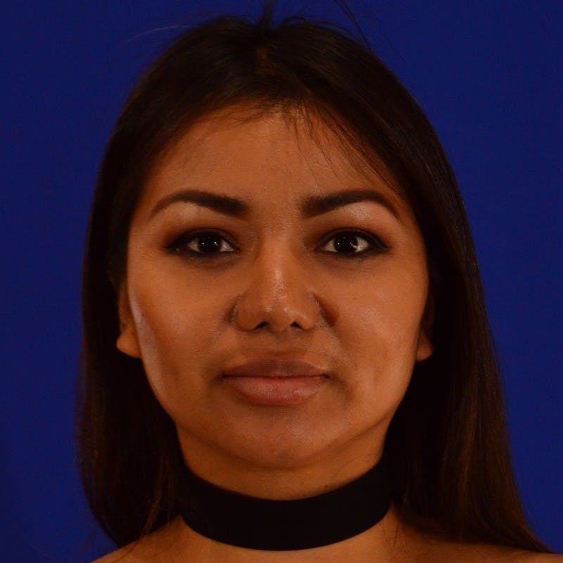 Revision Rhinoplasty Before & After Gallery - Patient 821065 - Image 6