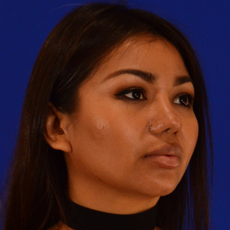 Revision Rhinoplasty Before & After Gallery - Patient 821065 - Image 4
