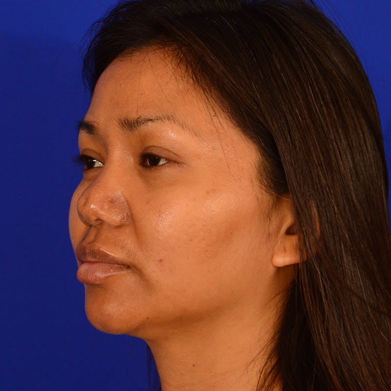 Revision Rhinoplasty Before & After Gallery - Patient 821065 - Image 7