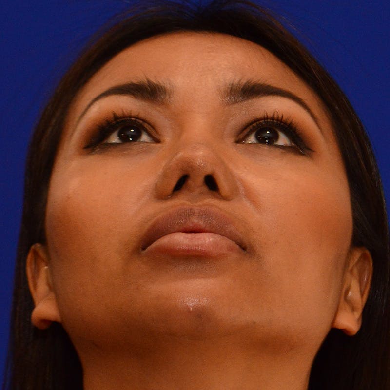 Revision Rhinoplasty Before & After Gallery - Patient 821065 - Image 12