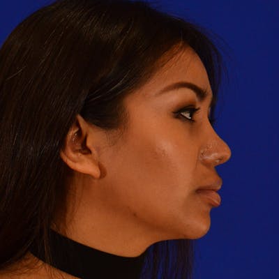 Revision Rhinoplasty Before & After Gallery - Patient 821065 - Image 2