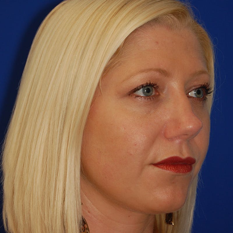 Upper Eyelid Surgery Before & After Gallery - Patient 195723 - Image 7