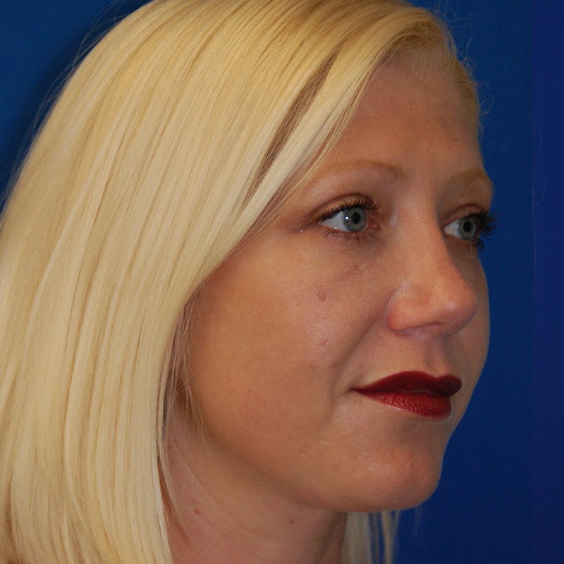 Upper Eyelid Surgery Before & After Gallery - Patient 195723 - Image 8
