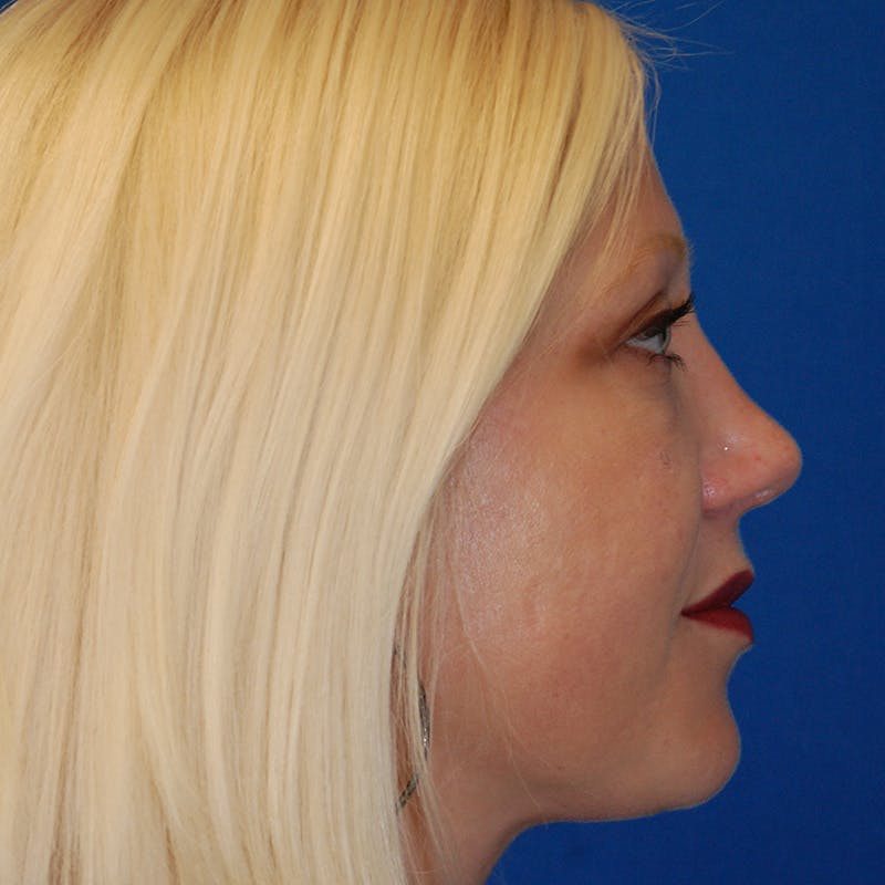 Upper Eyelid Surgery Before & After Gallery - Patient 195723 - Image 10