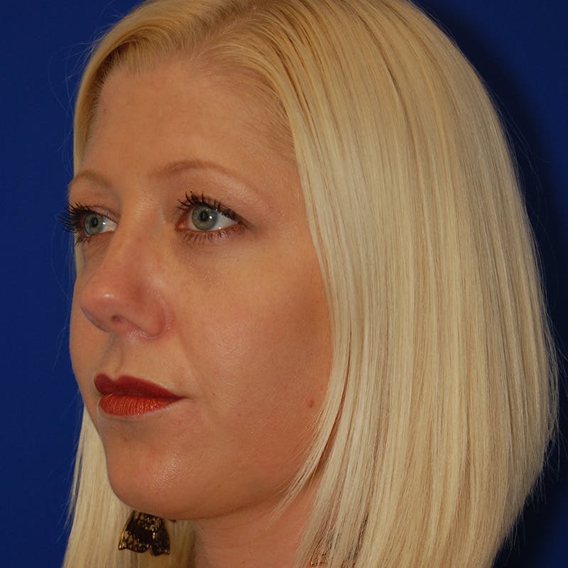Upper Eyelid Surgery Before & After Gallery - Patient 195723 - Image 3