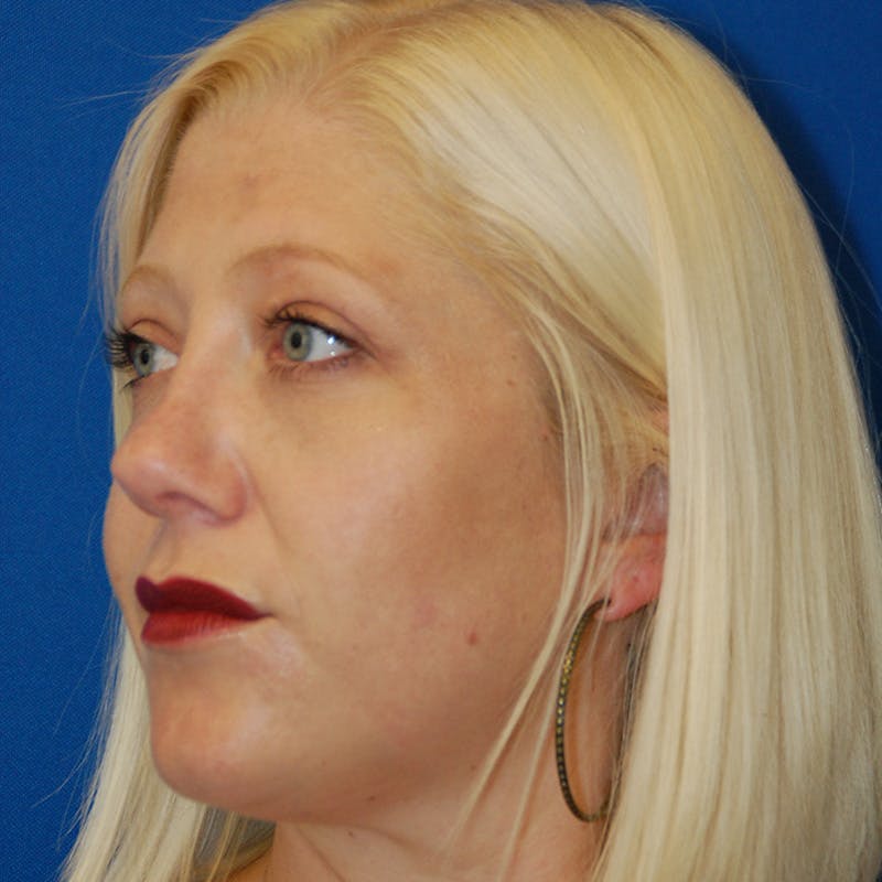 Upper Eyelid Surgery Before & After Gallery - Patient 195723 - Image 4