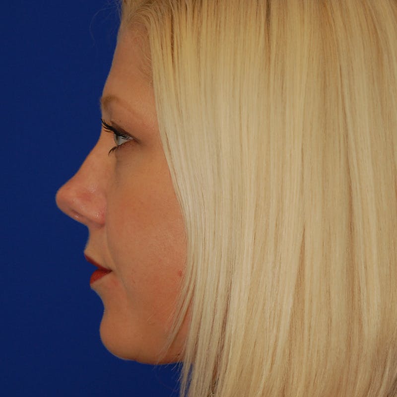 Upper Eyelid Surgery Before & After Gallery - Patient 195723 - Image 5