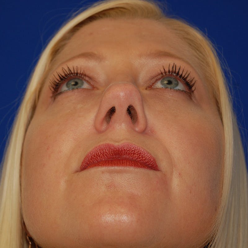 Upper Eyelid Surgery Before & After Gallery - Patient 195723 - Image 11
