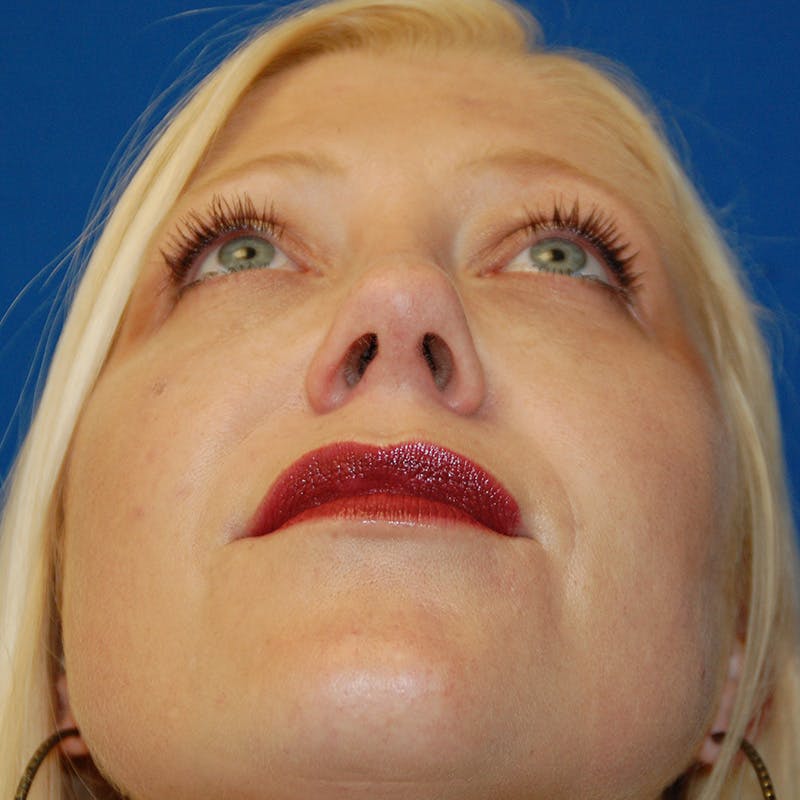 Upper Eyelid Surgery Before & After Gallery - Patient 195723 - Image 12