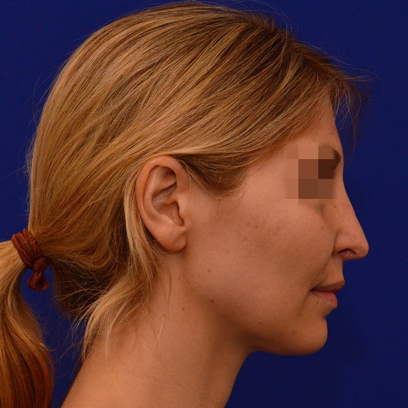 Revision Rhinoplasty Before & After Gallery - Patient 271439 - Image 1