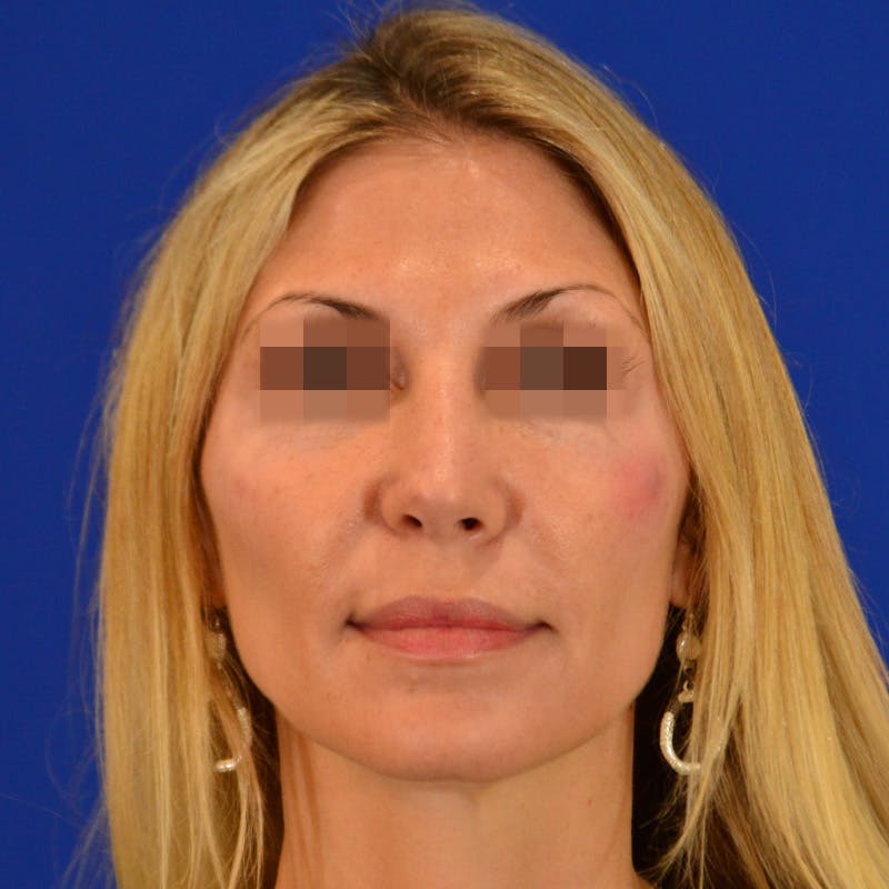 Revision Rhinoplasty Before & After Gallery - Patient 271439 - Image 8