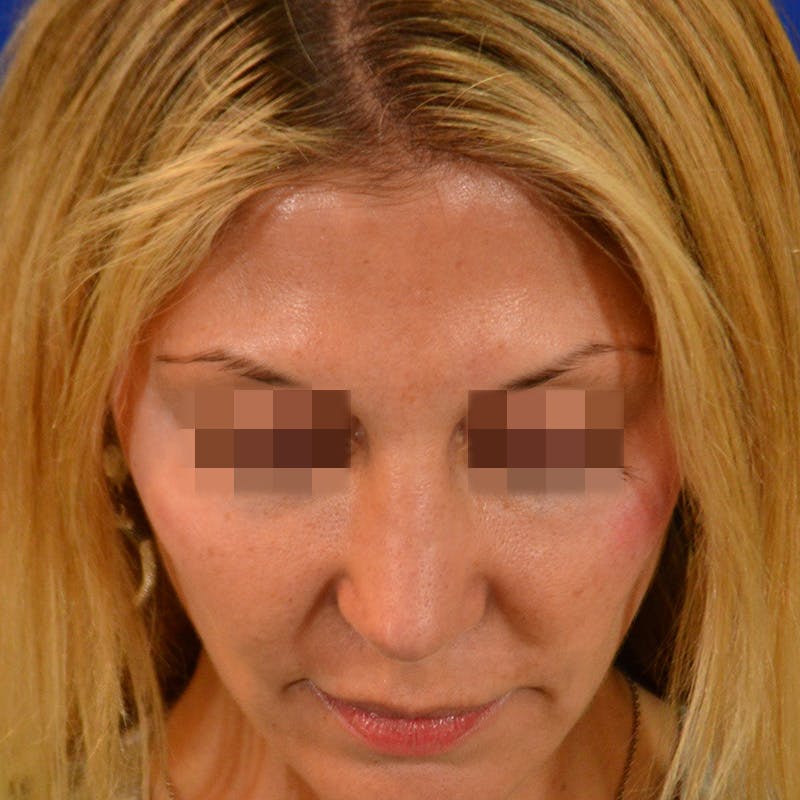 Revision Rhinoplasty Before & After Gallery - Patient 271439 - Image 12