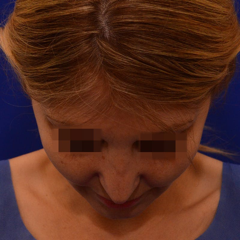 Revision Rhinoplasty Before & After Gallery - Patient 271439 - Image 13