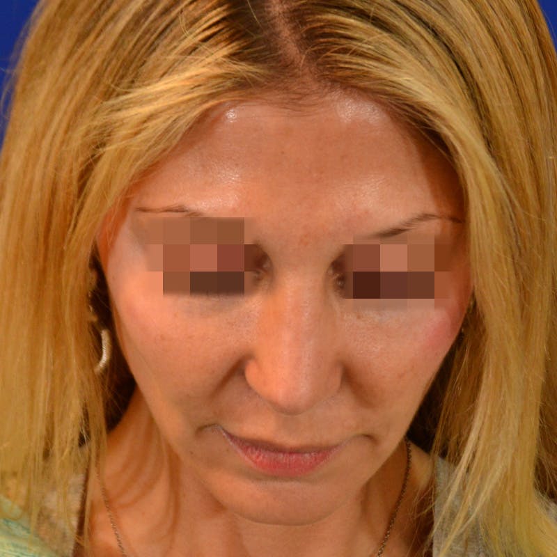 Revision Rhinoplasty Before & After Gallery - Patient 271439 - Image 14